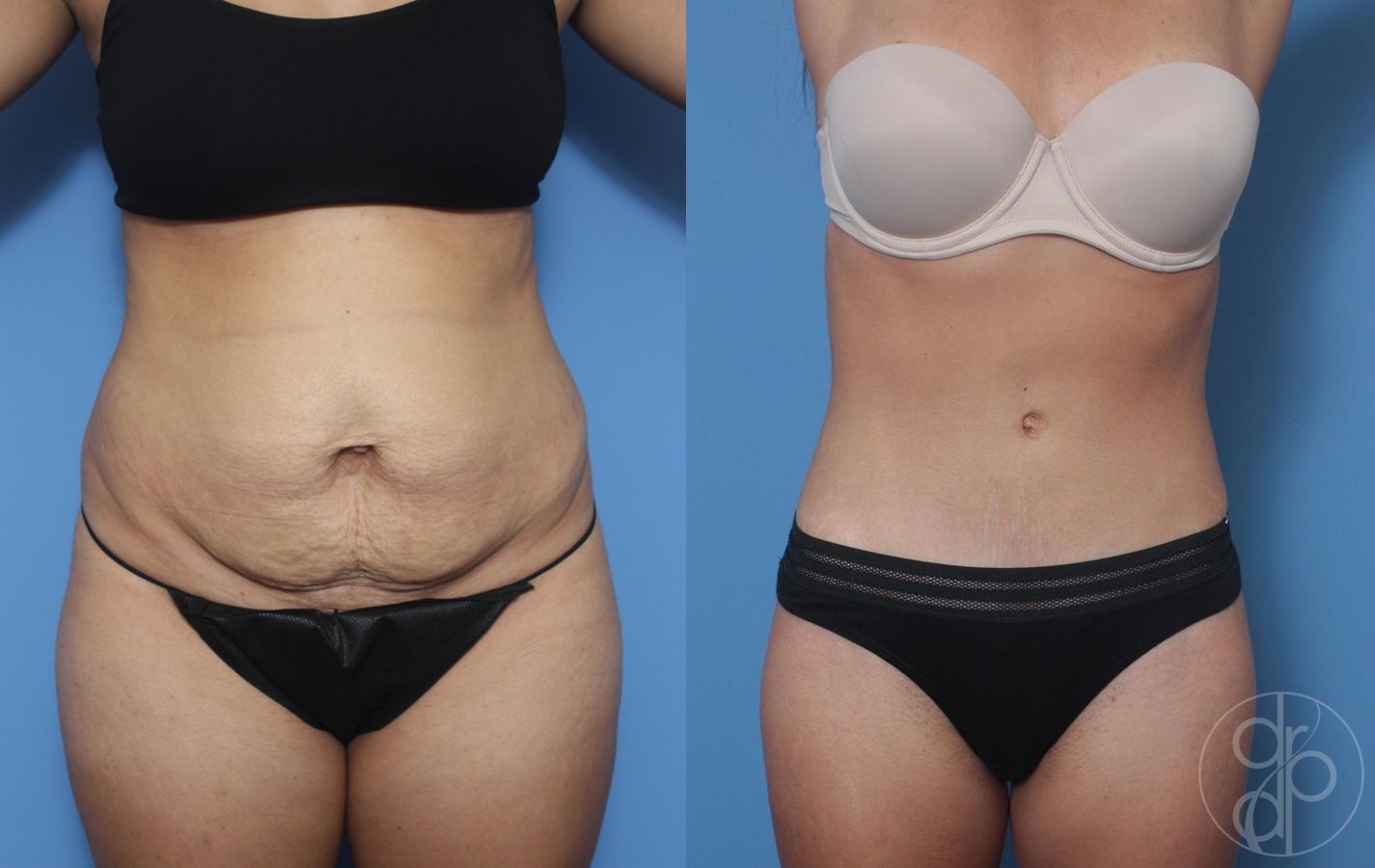 Before and after Abdominoplasty case 29531
