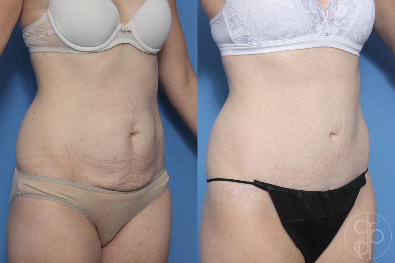 Before and after Abdominoplasty case 29570
