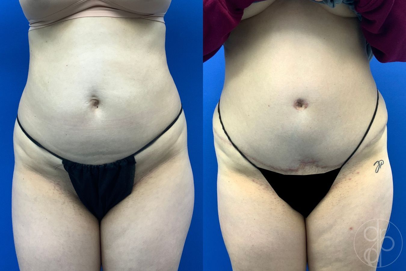 Before and after Abdominoplasty case 43481