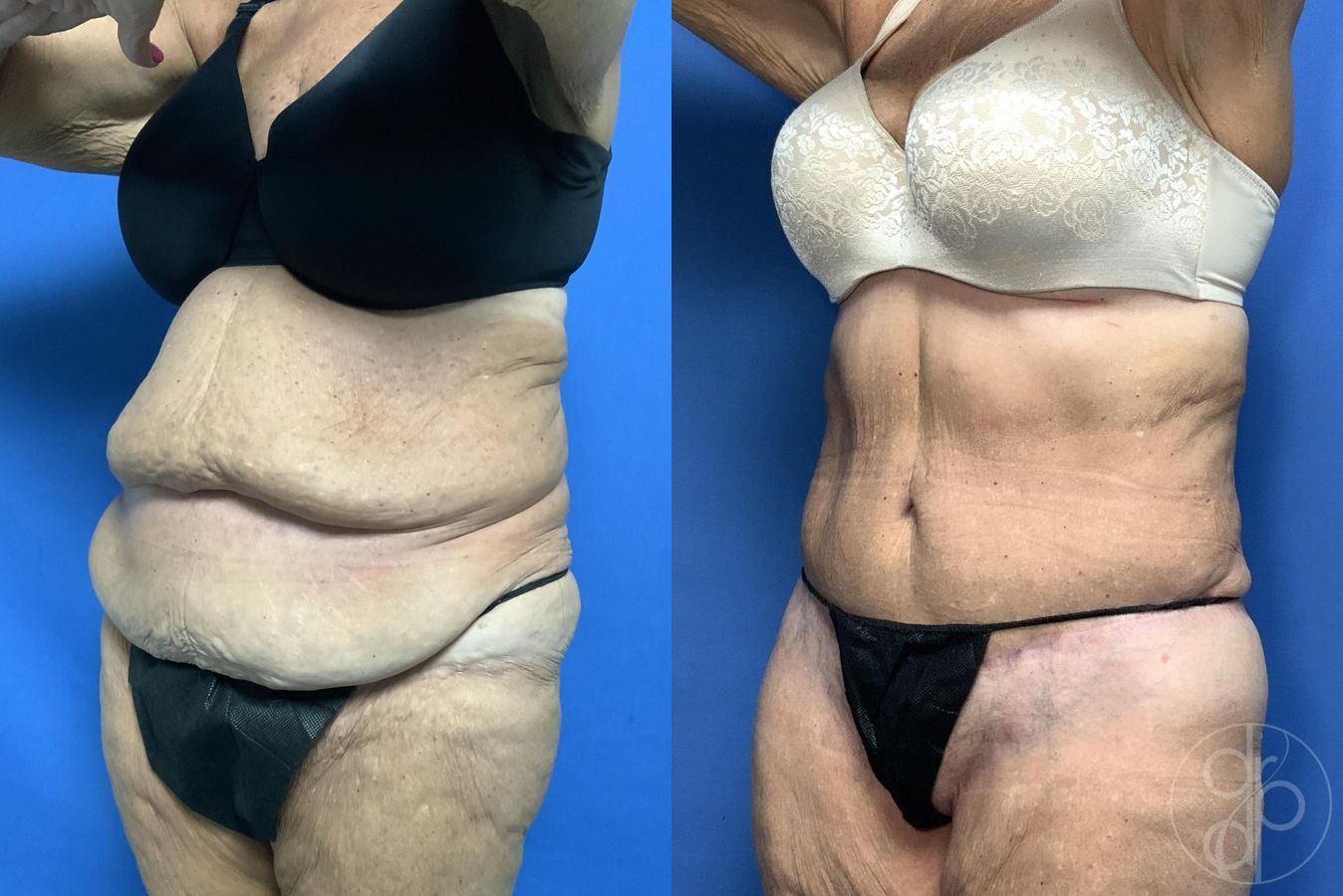 Before and after Abdominoplasty case 29620 - Angle 3