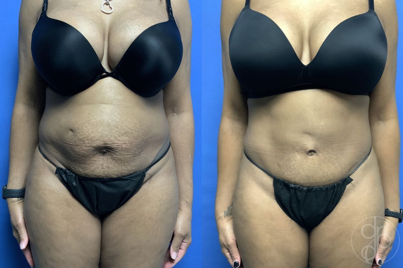 Abdominoplasty - Case 275