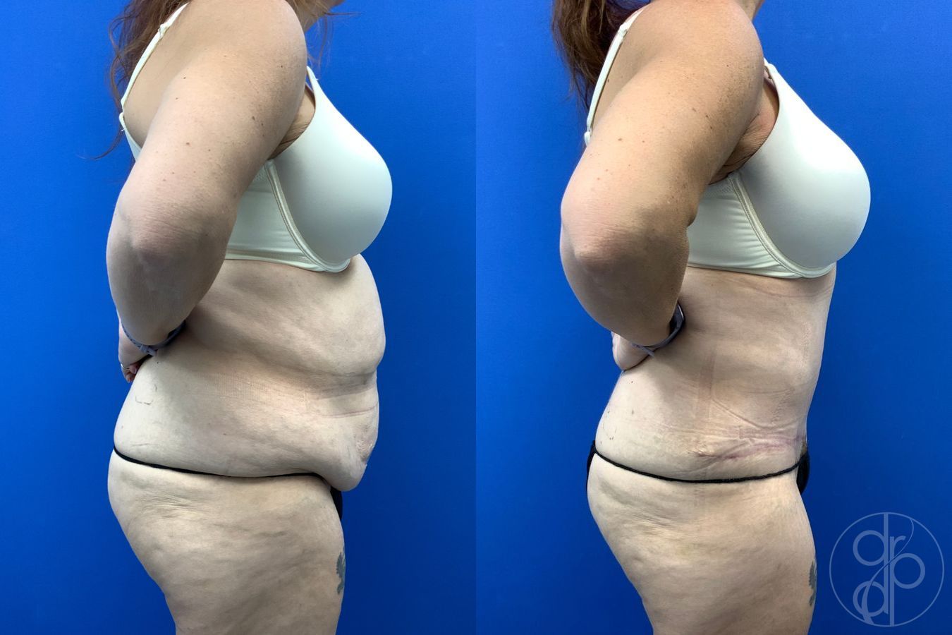 Before and after Abdominoplasty case 43458 - Angle 6