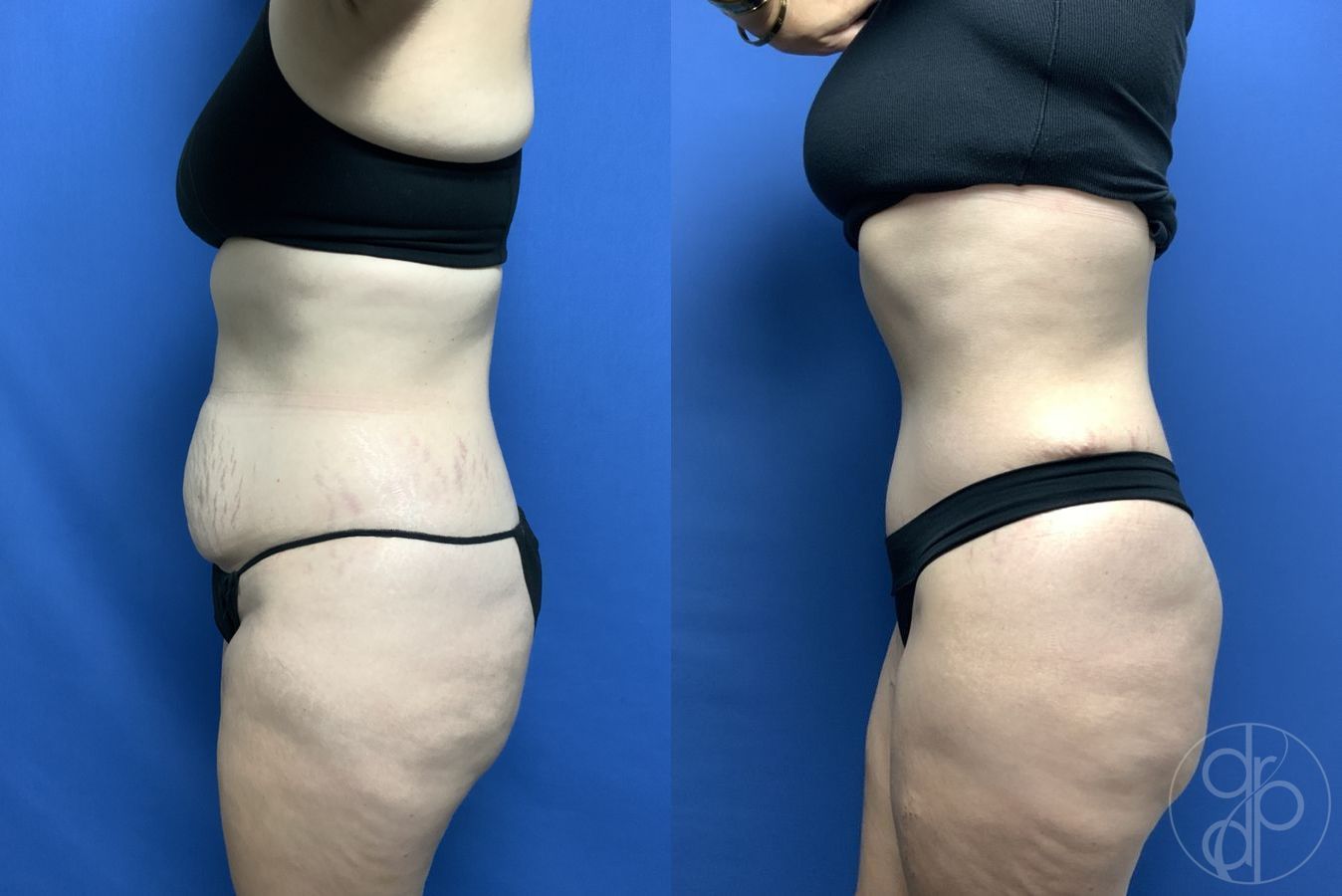 Before and after Abdominoplasty case 29538 - Angle 3