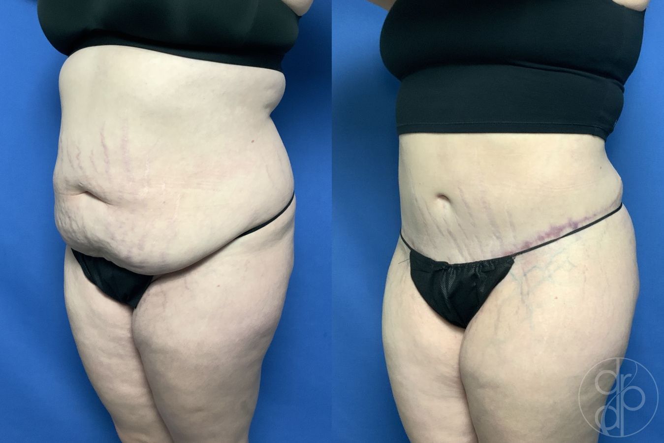 Before and after Abdominoplasty case 29576 - Angle 3
