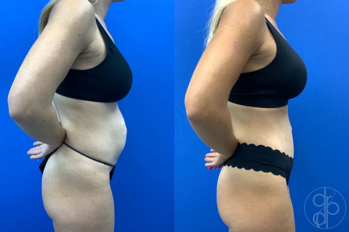 Before and after Abdominoplasty case 49485 - Angle 6