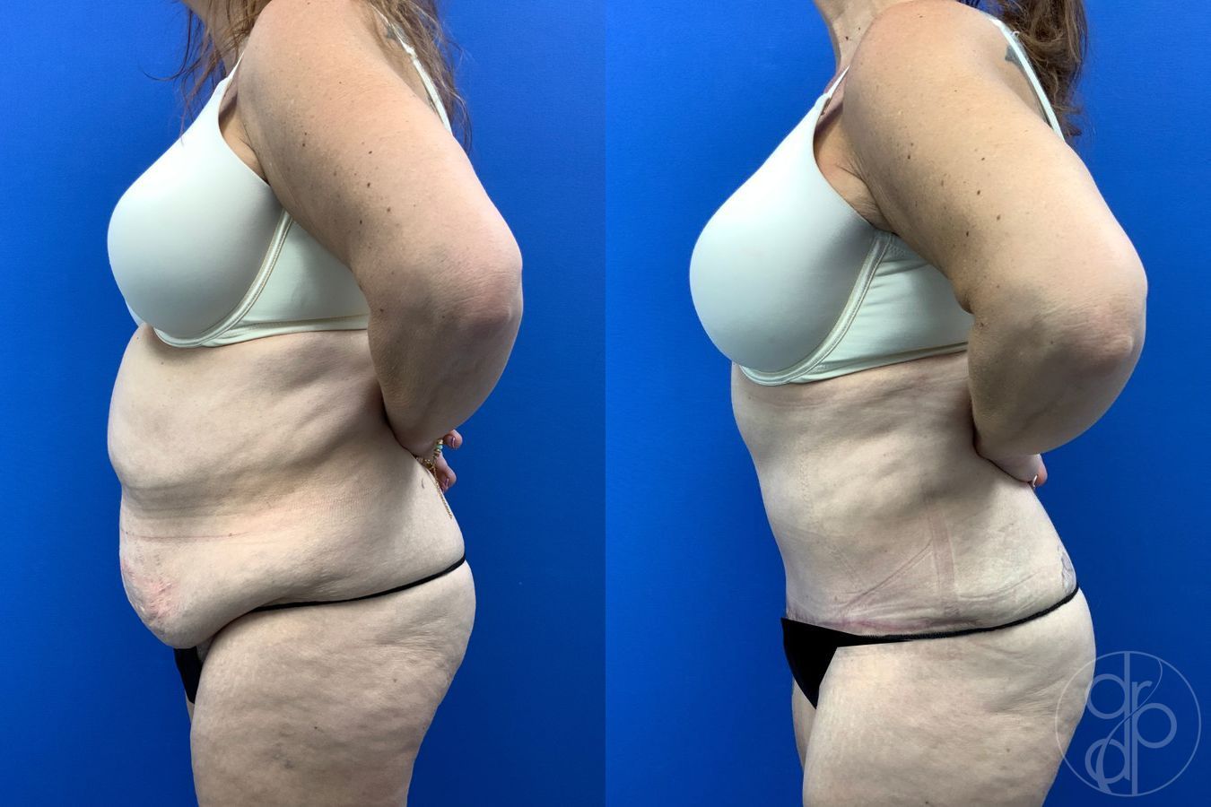 Before and after Abdominoplasty case 43458 - Angle 4
