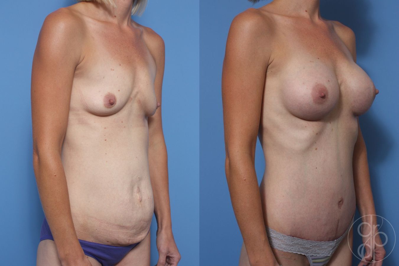 Before and after Abdominoplasty case 29692 - Angle 2