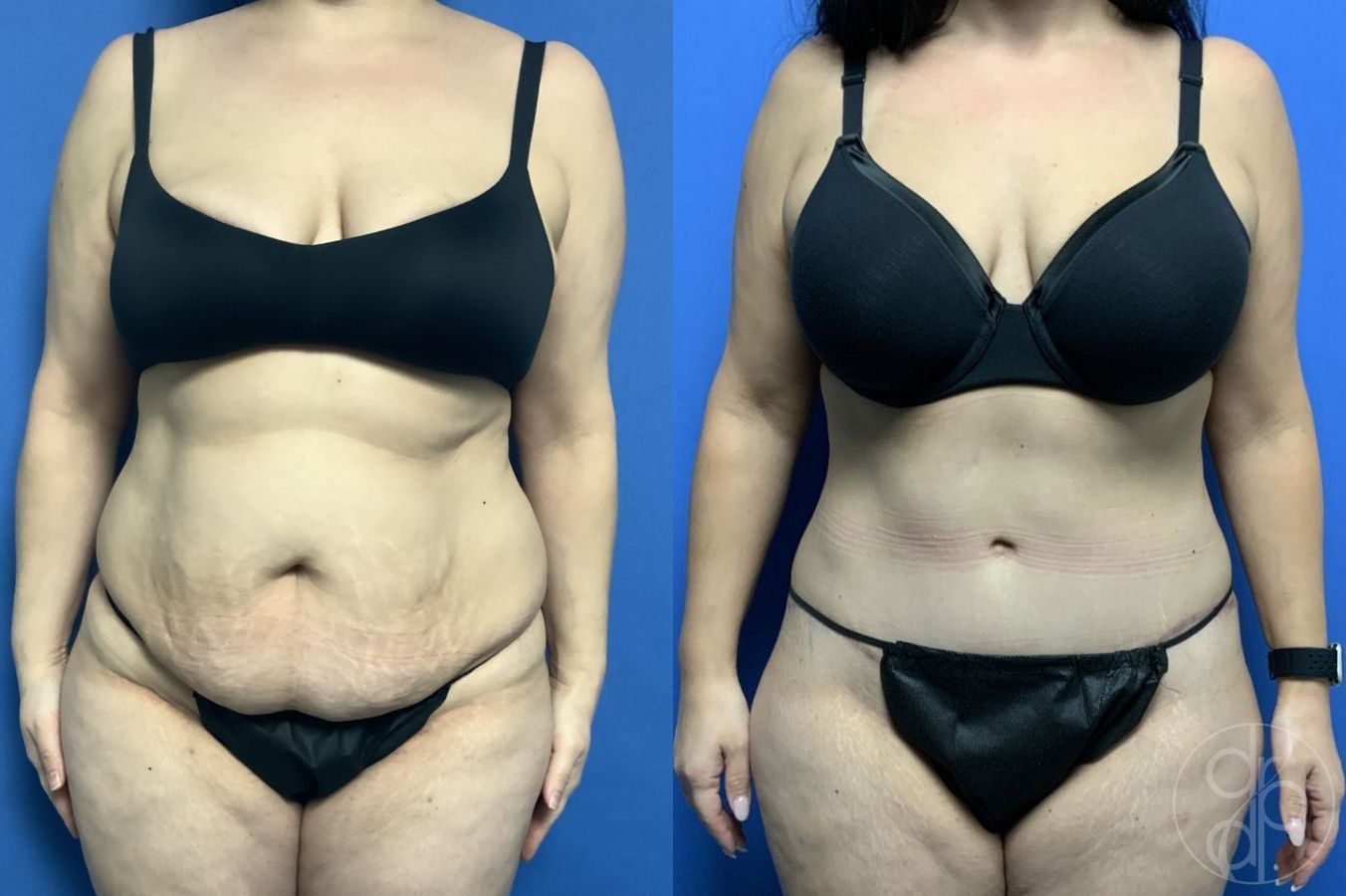 Before and after Abdominoplasty case 29575