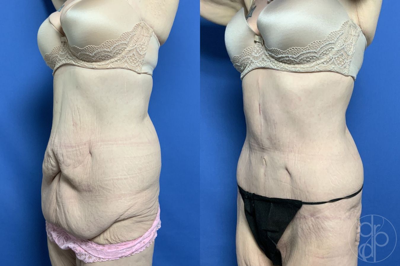 Before and after Abdominoplasty case 29535 - Angle 3