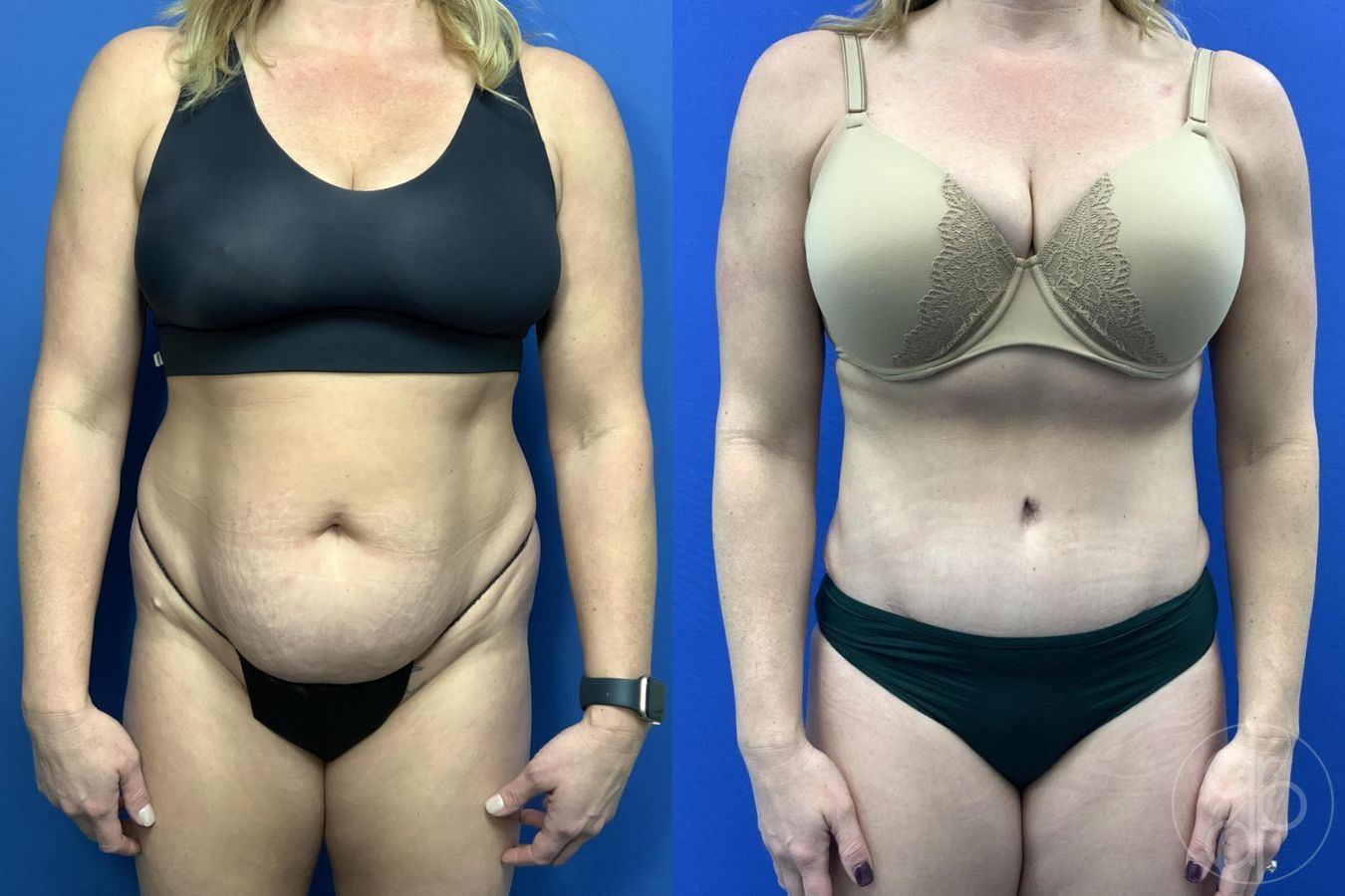 Before and after Abdominoplasty case 29762