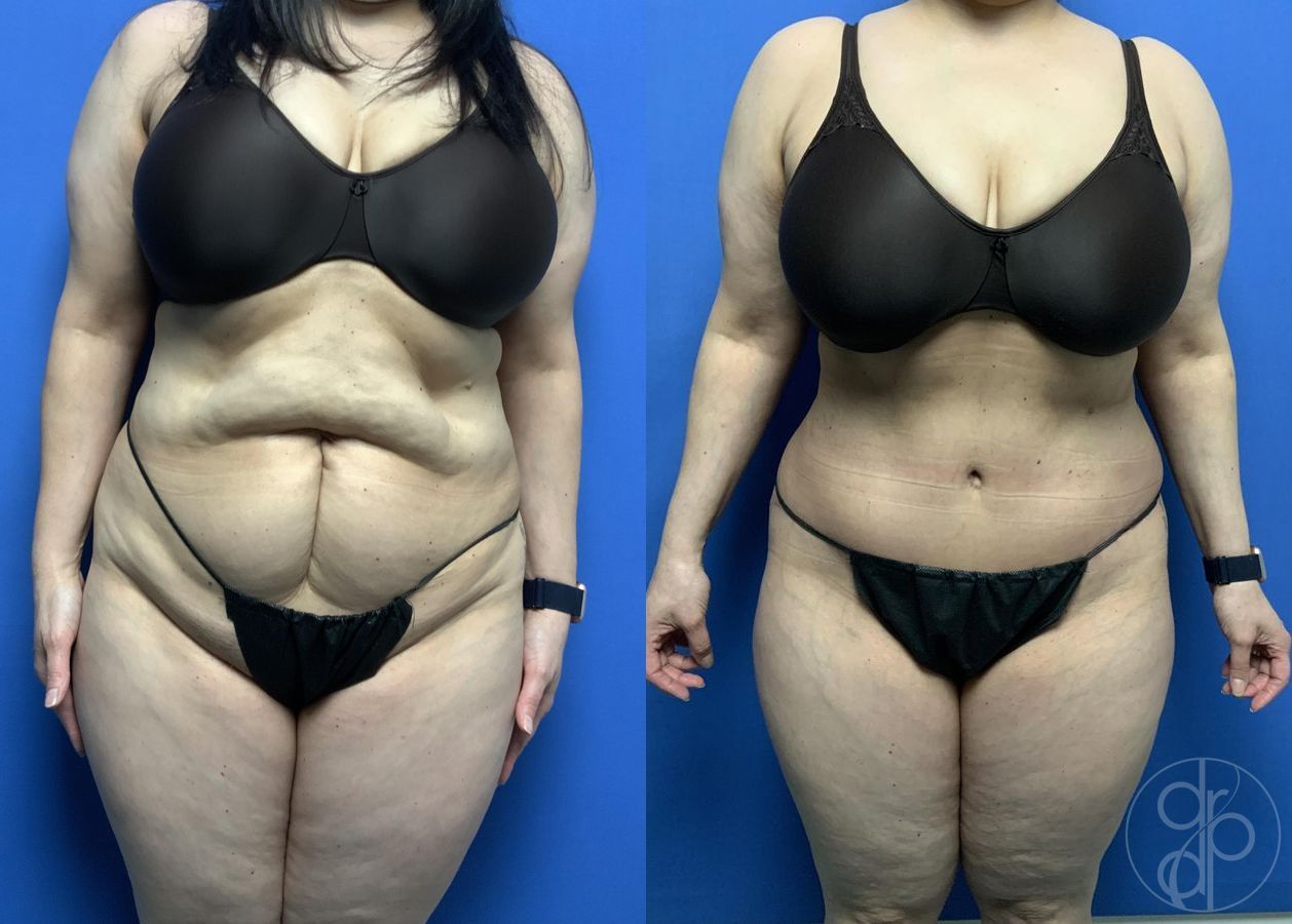 Before and after Abdominoplasty case 29569