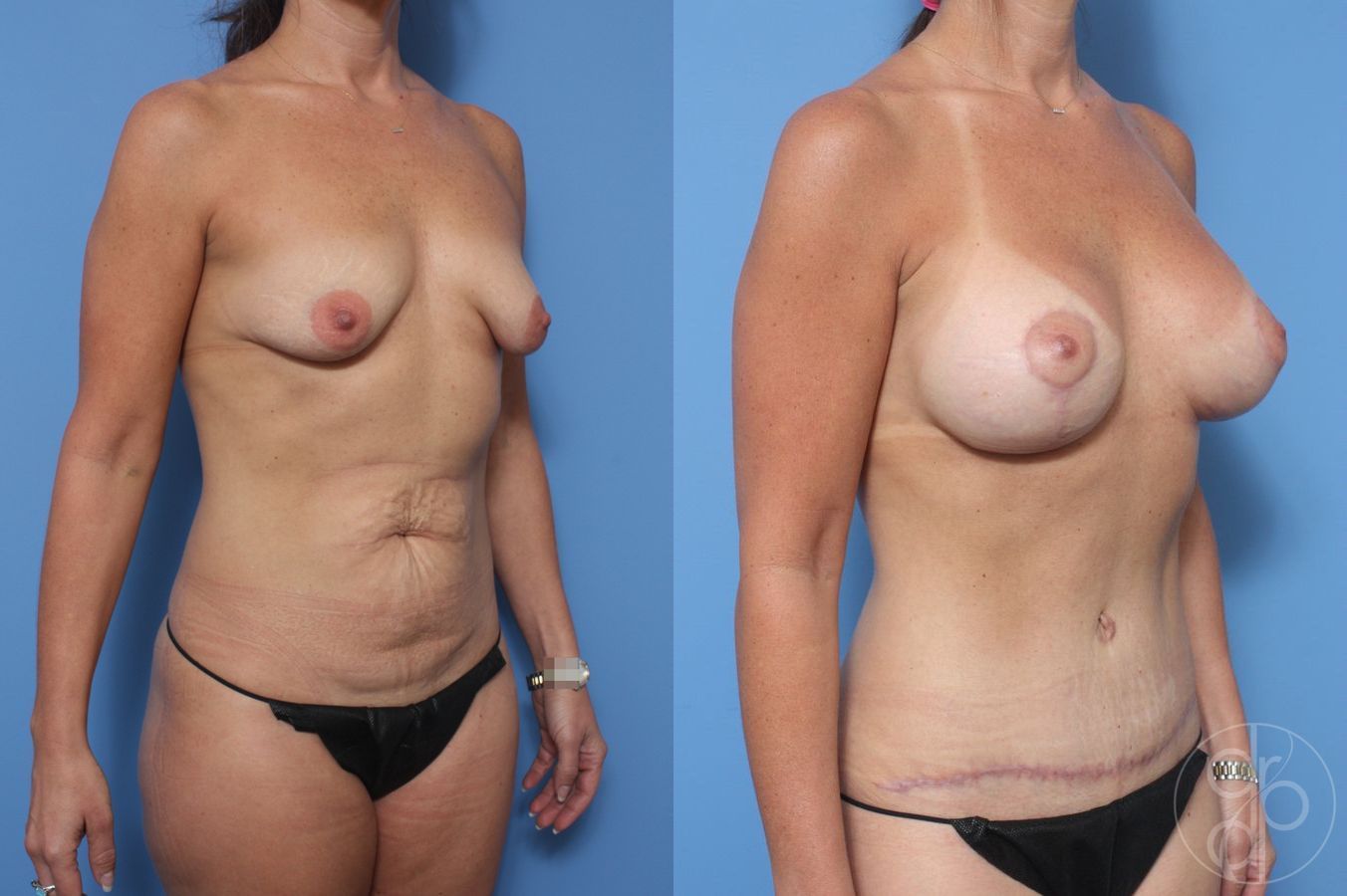 Before and after Abdominoplasty case 29684 - Angle 3