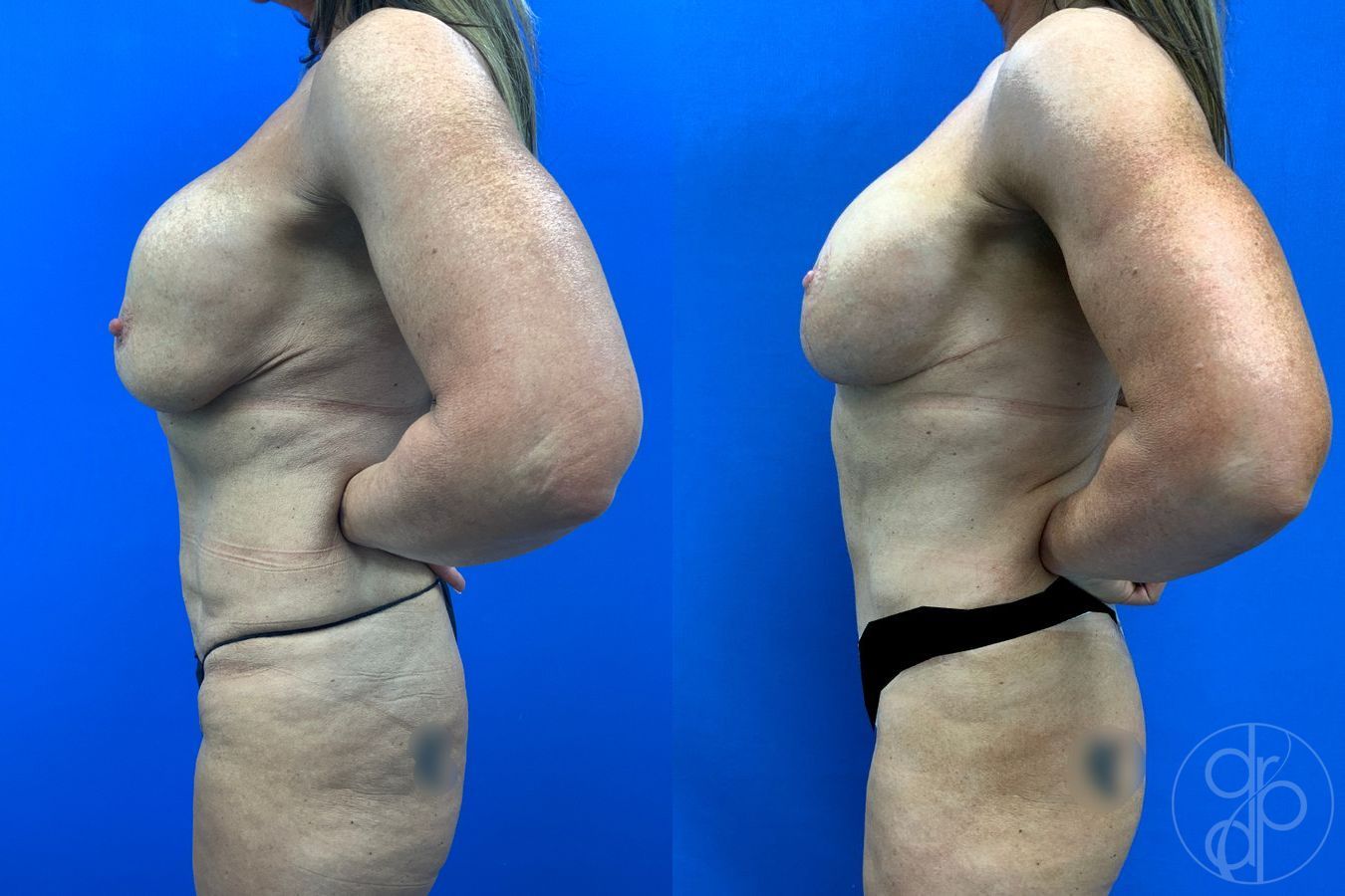 Before and after Mommy Makeover case 50316 - Angle 4