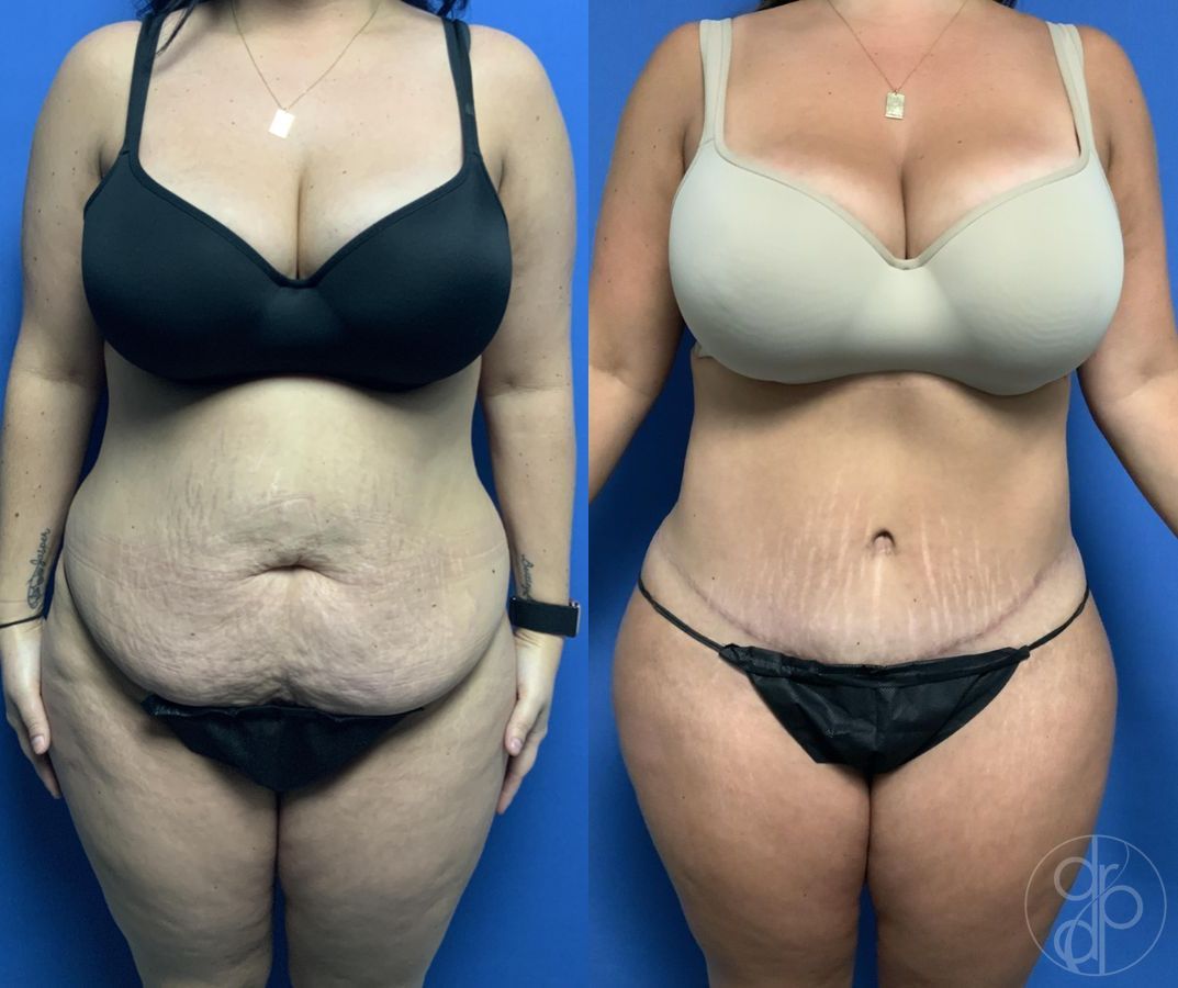 Before and after Abdominoplasty case 29578
