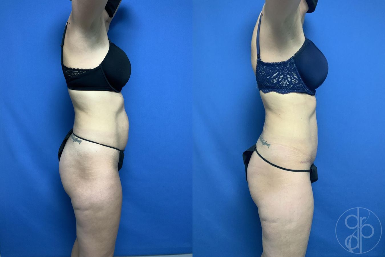 Abdominoplasty - Thumbnail 2