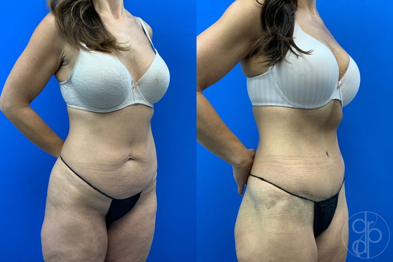 Before and after Abdominoplasty case 43480 - Angle 7