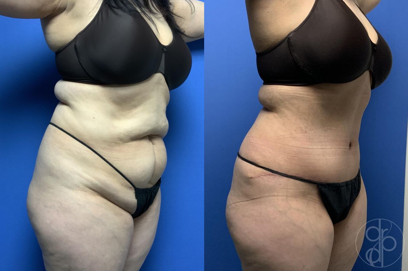 Before and after Abdominoplasty case 29569 - Angle 2