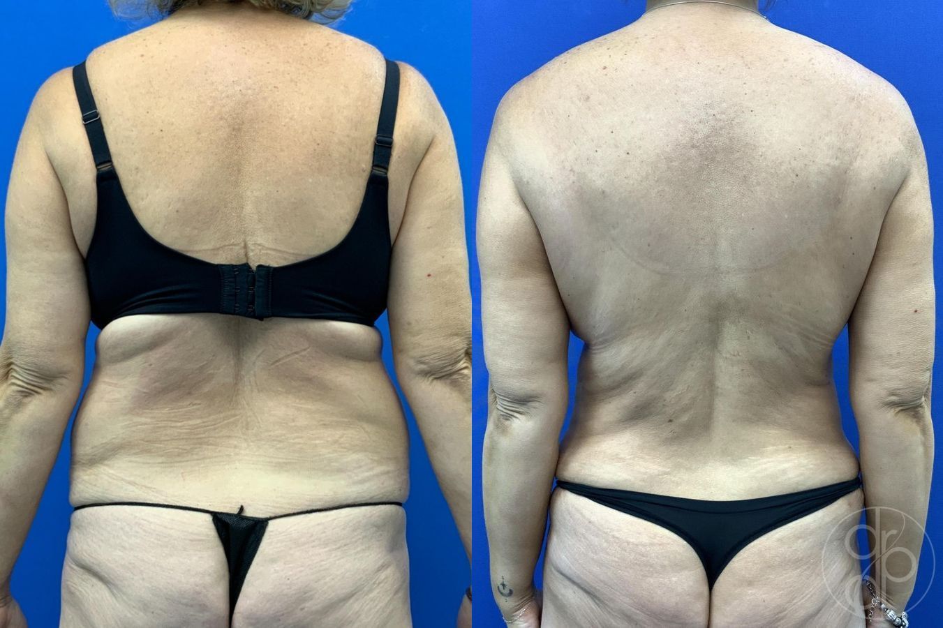 Abdominoplasty - Thumbnail 5