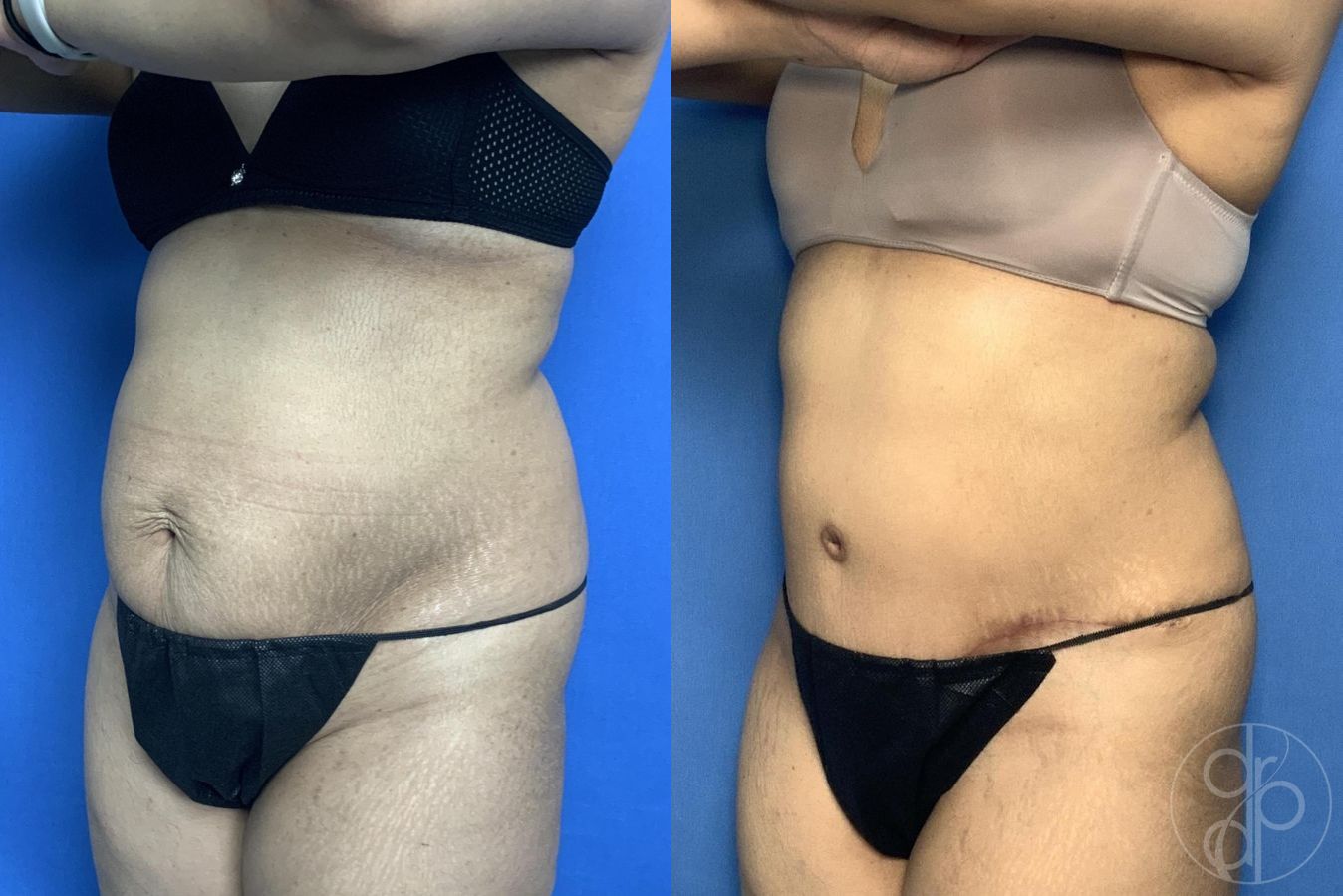 Before and after Abdominoplasty case 29583 - Angle 2