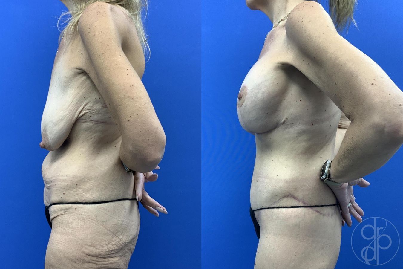 Before and after Abdominoplasty case 29983 - Angle 6