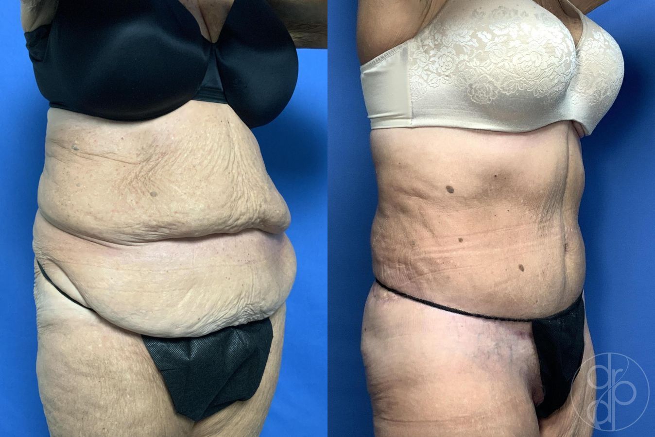 Before and after Abdominoplasty case 29620 - Angle 7