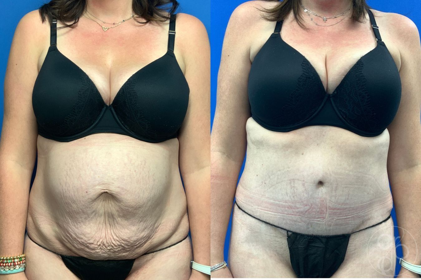 Before and after Abdominoplasty case 43192