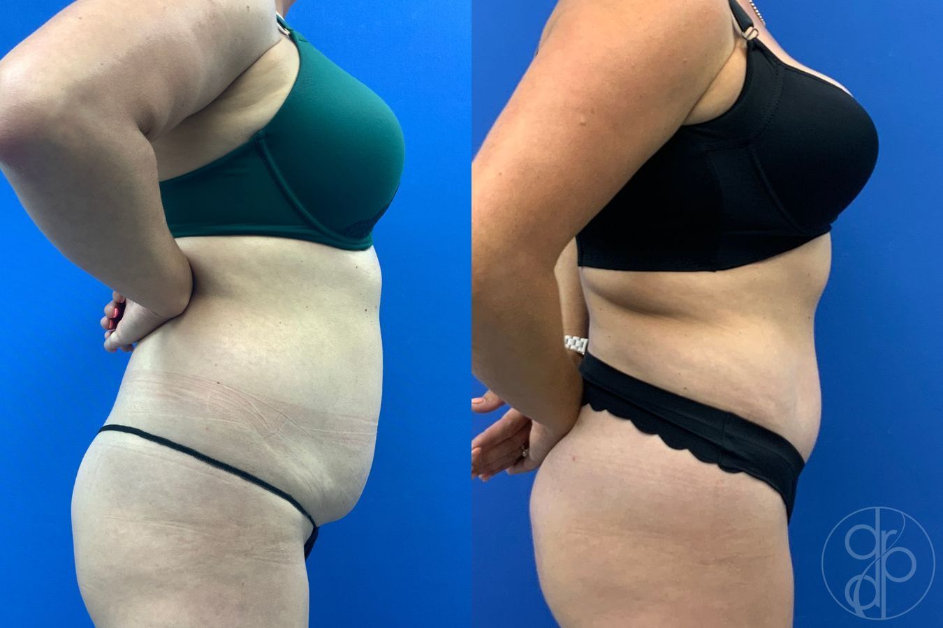 Before and after Liposuction case 43486 - Angle 3