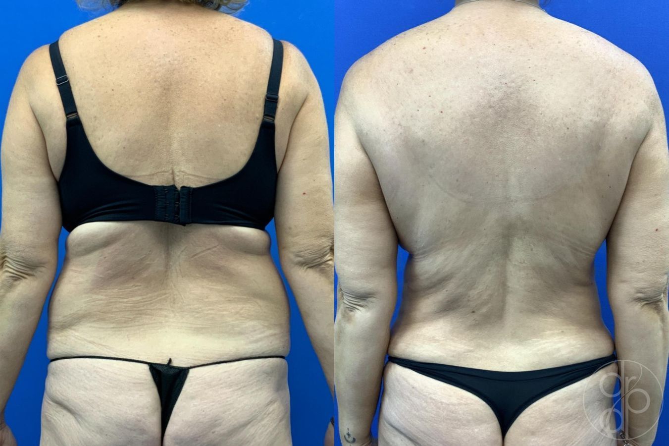 Before and after Abdominoplasty case 29619 - Angle 5