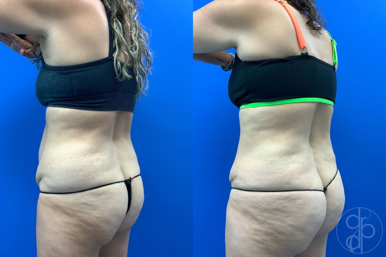 Before and after Liposuction case 43452 - Angle 7