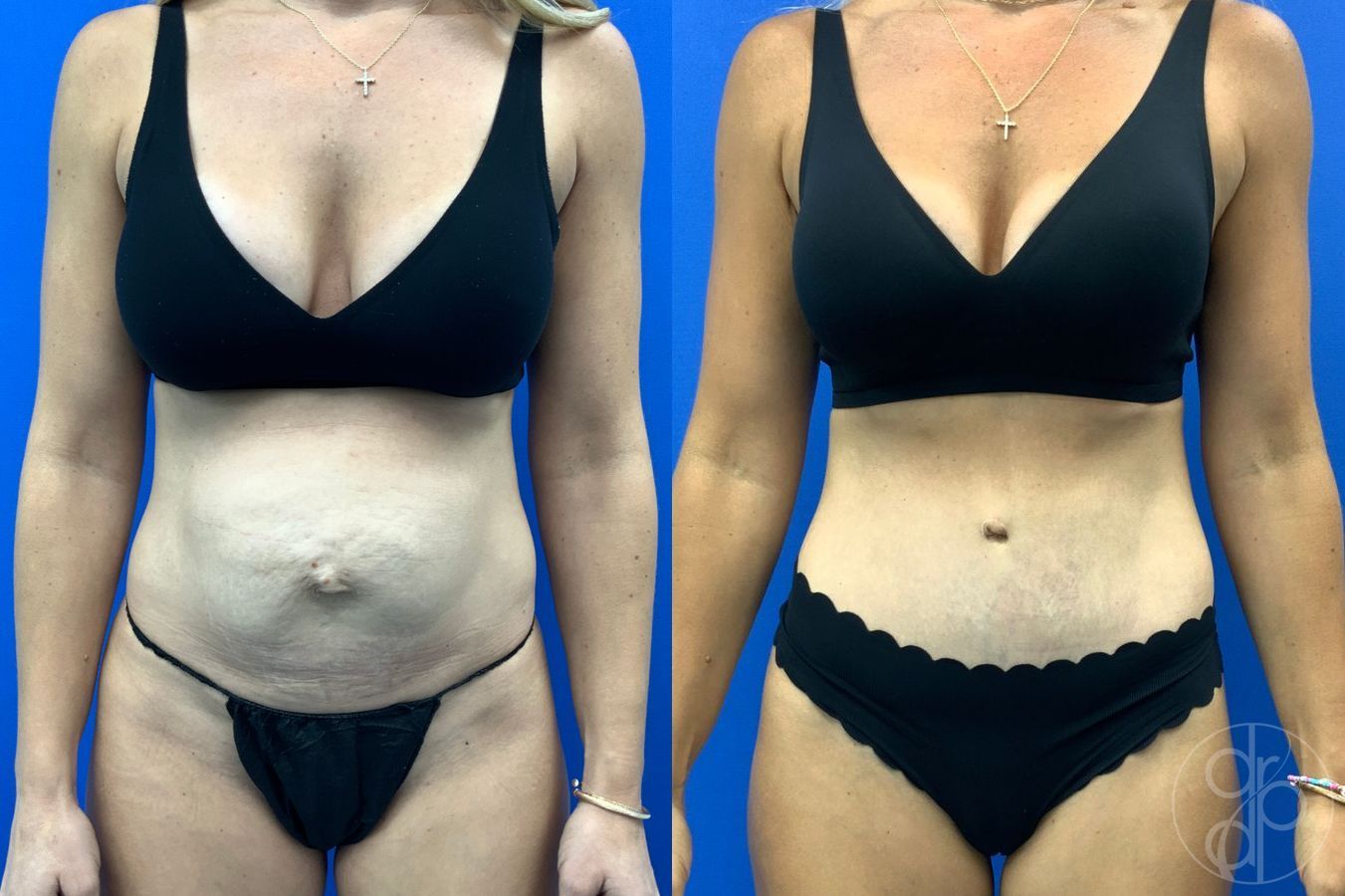 Before and after Abdominoplasty case 49485