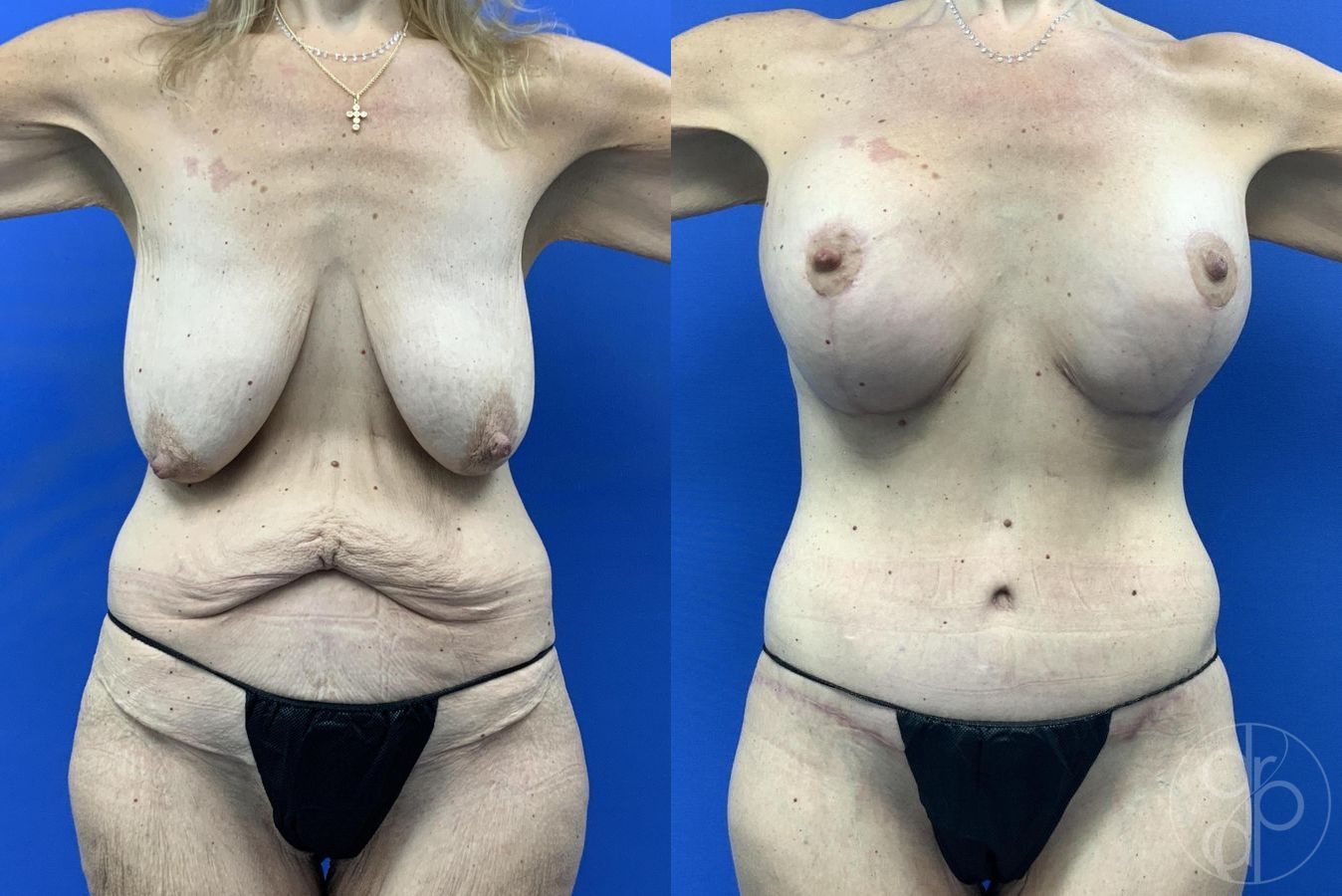 Before and after Abdominoplasty case 29983 - Angle 2