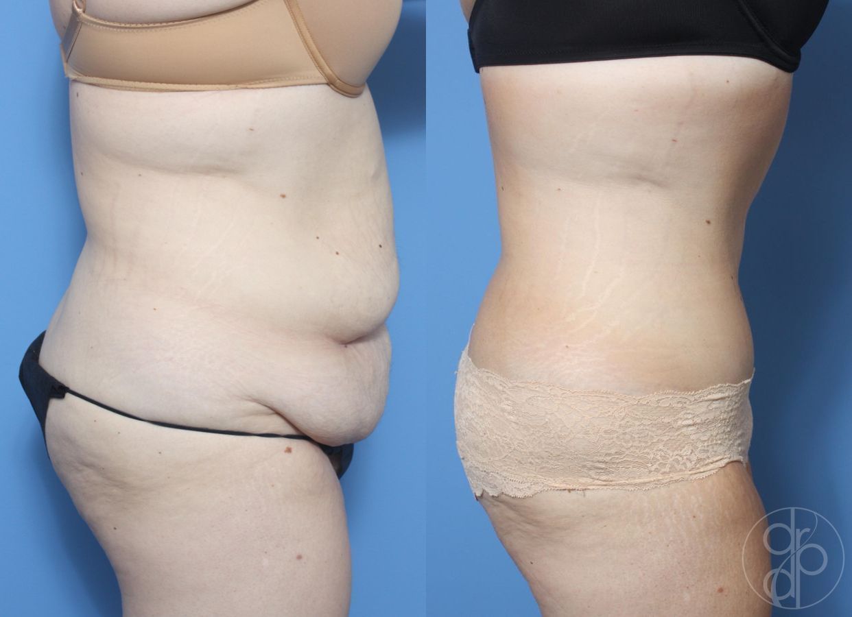 Before and after Abdominoplasty case 29544 - Angle 2