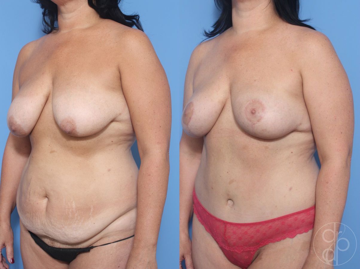 Before and after Abdominoplasty case 29695 - Angle 3