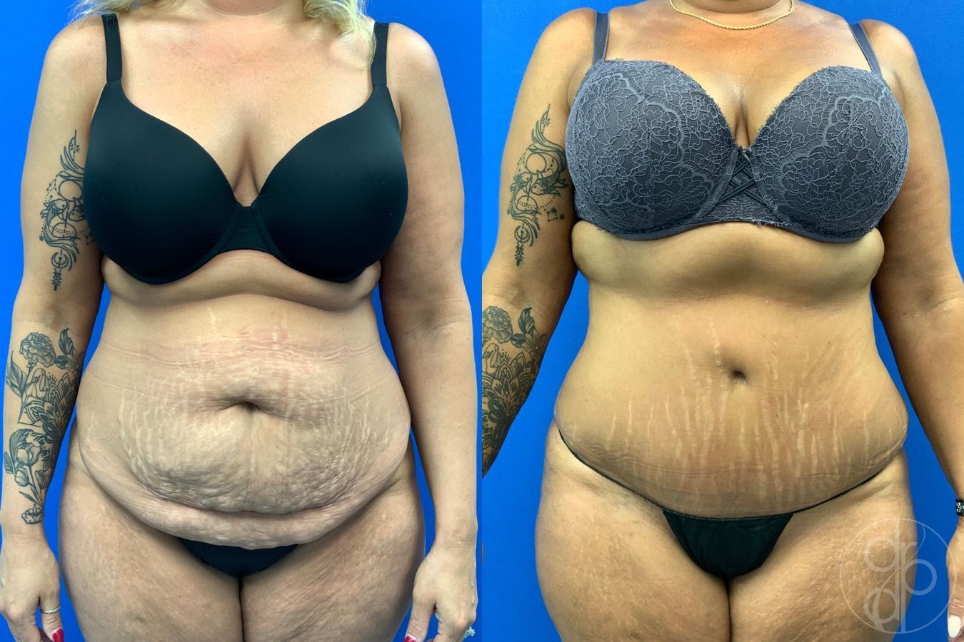 Before and after Abdominoplasty case 43473
