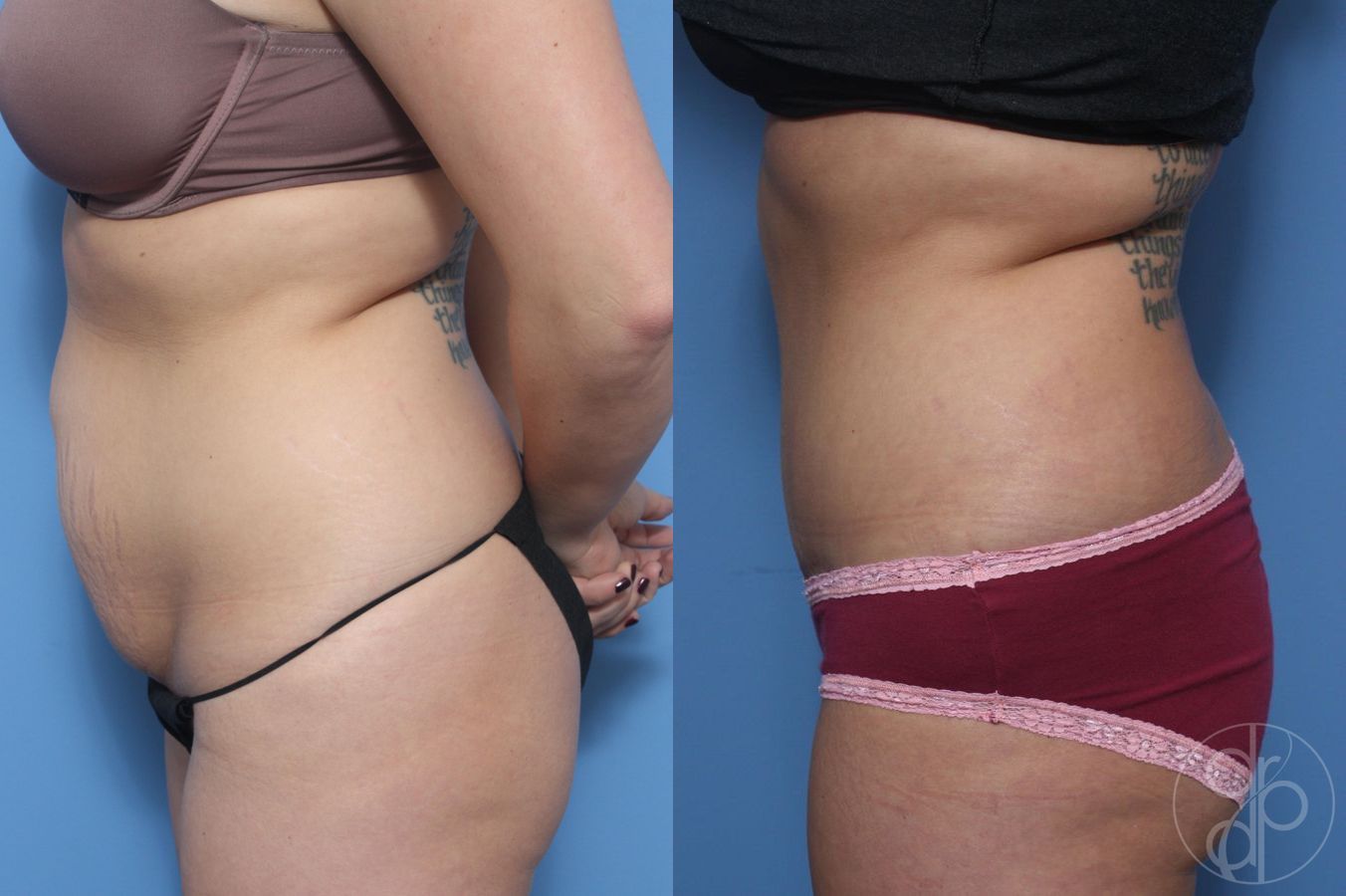Before and after Abdominoplasty case 29526 - Angle 2