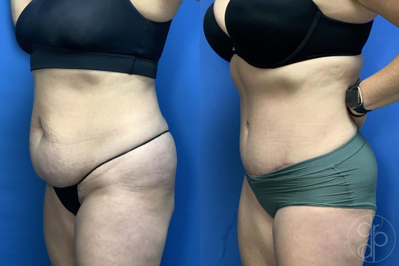 Before and after Abdominoplasty case 29993 - Angle 3