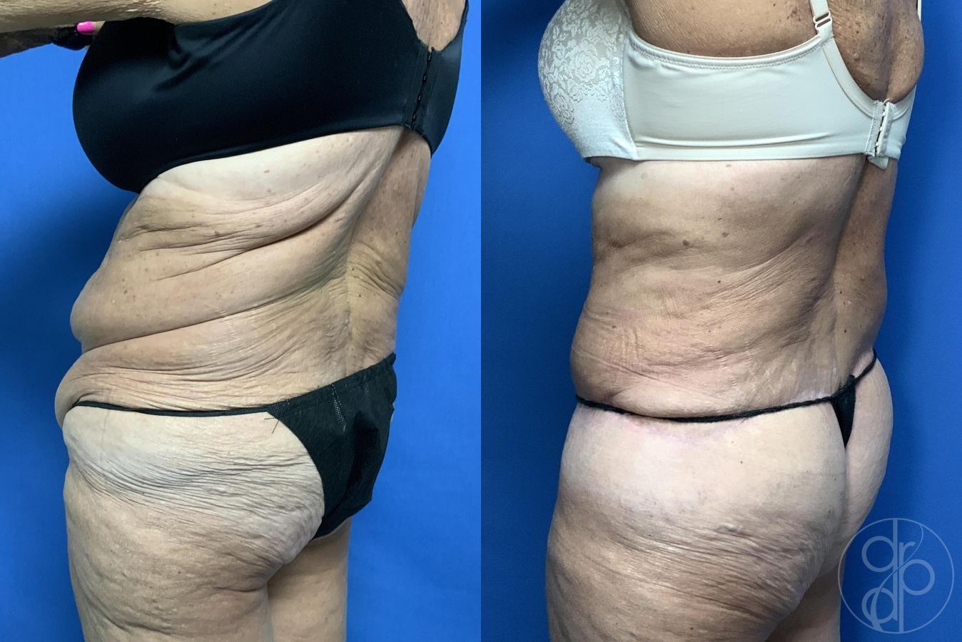 Before and after Abdominoplasty case 29620 - Angle 4