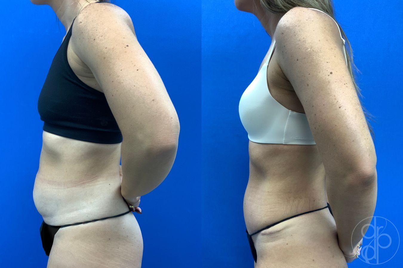 Before and after Abdominoplasty case 43175 - Angle 6