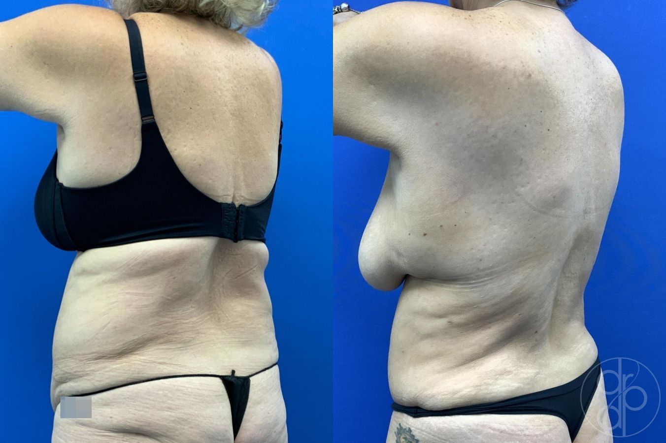Before and after Abdominoplasty case 29619 - Angle 7