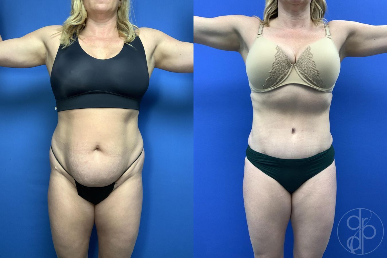 Before and after Abdominoplasty case 29762 - Angle 2