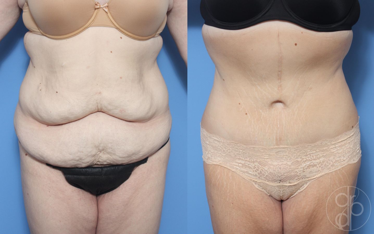 Before and after Abdominoplasty case 29544