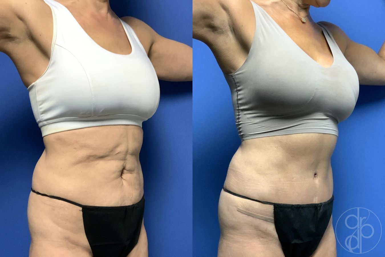 Before and after Abdominoplasty case 29647 - Angle 3