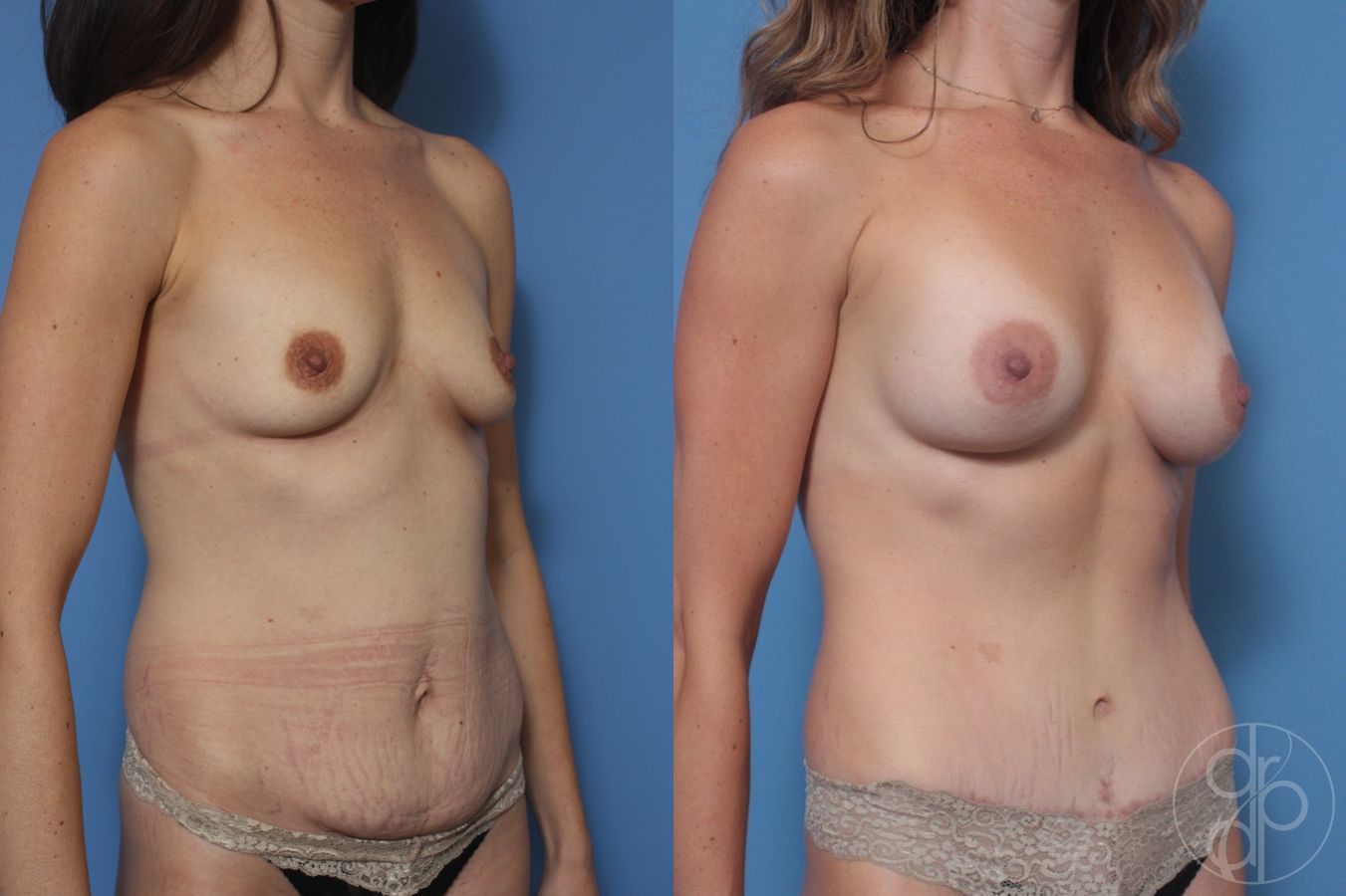 Abdominoplasty - Thumbnail 2