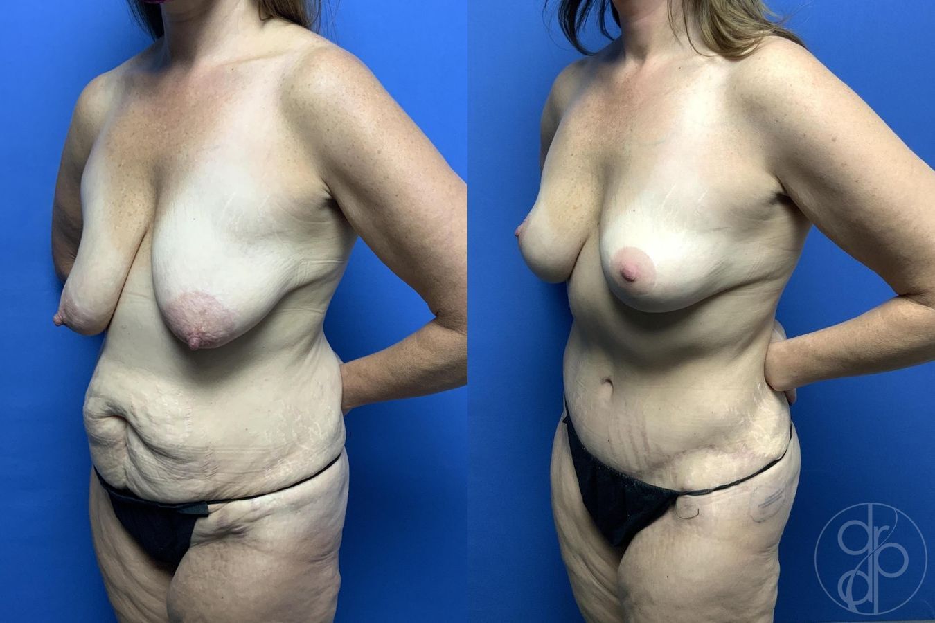 Before and after Abdominoplasty case 29694 - Angle 4