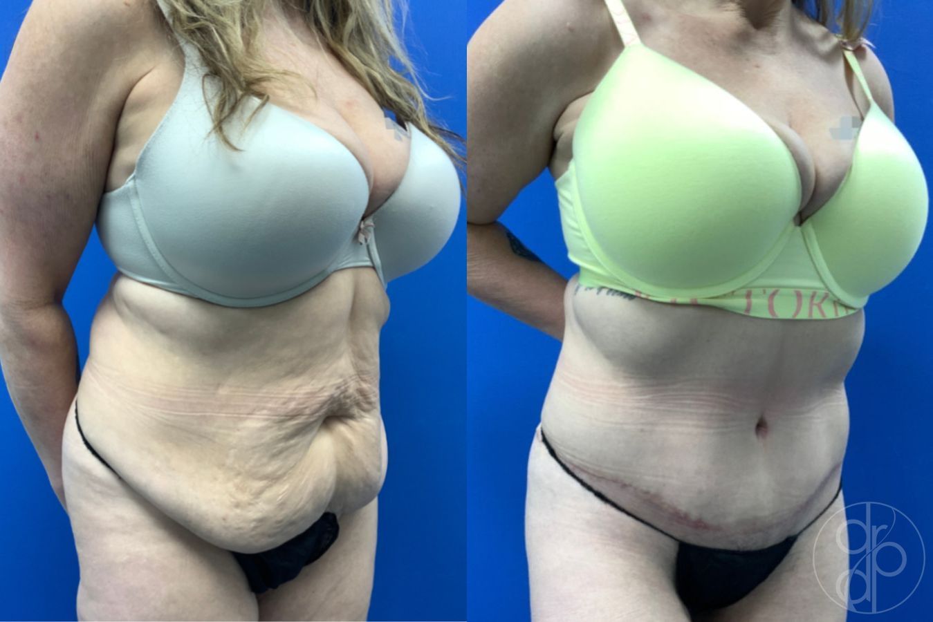 Before and after Abdominoplasty case 46426 - Angle 4