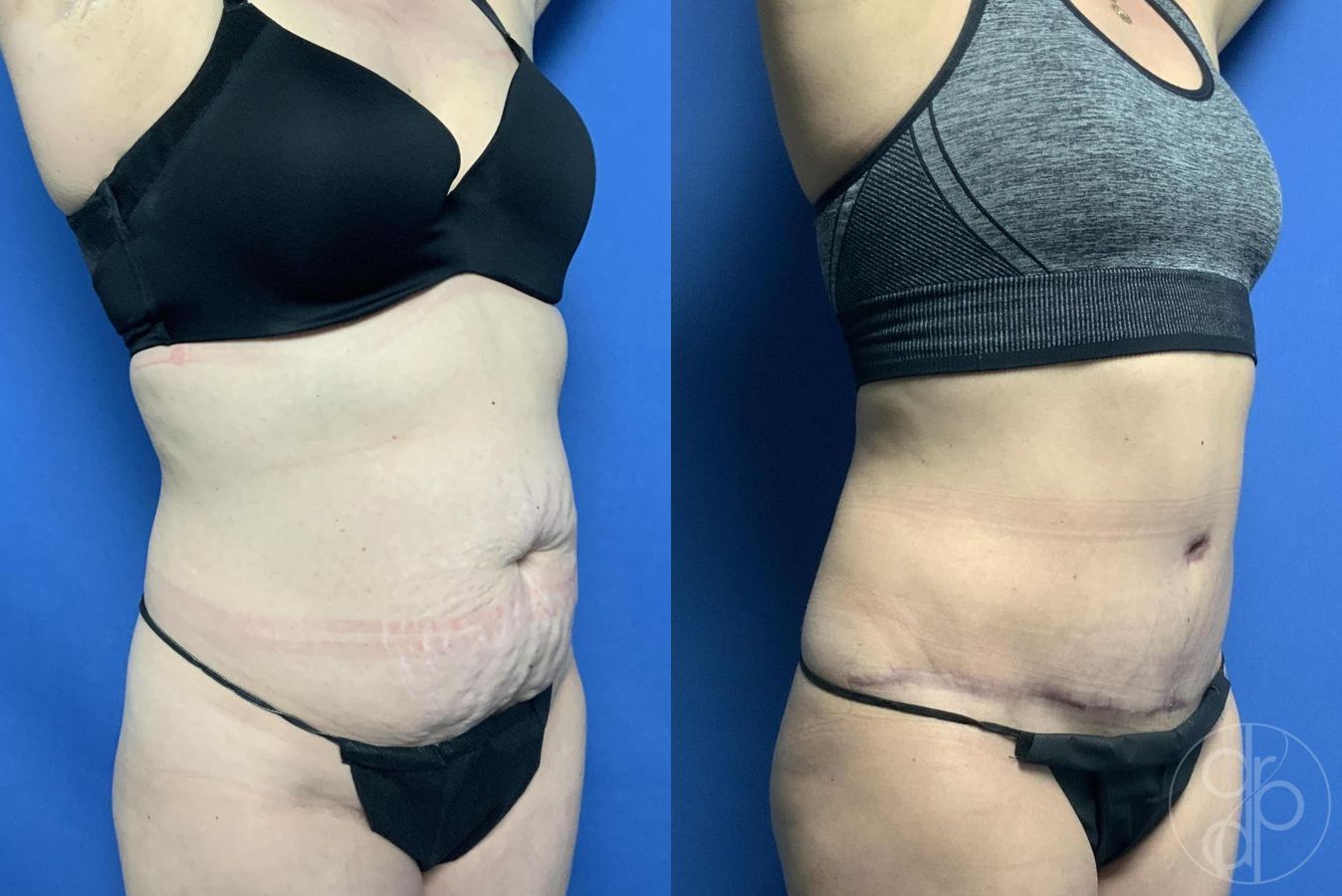 Before and after Abdominoplasty case 29563 - Angle 3