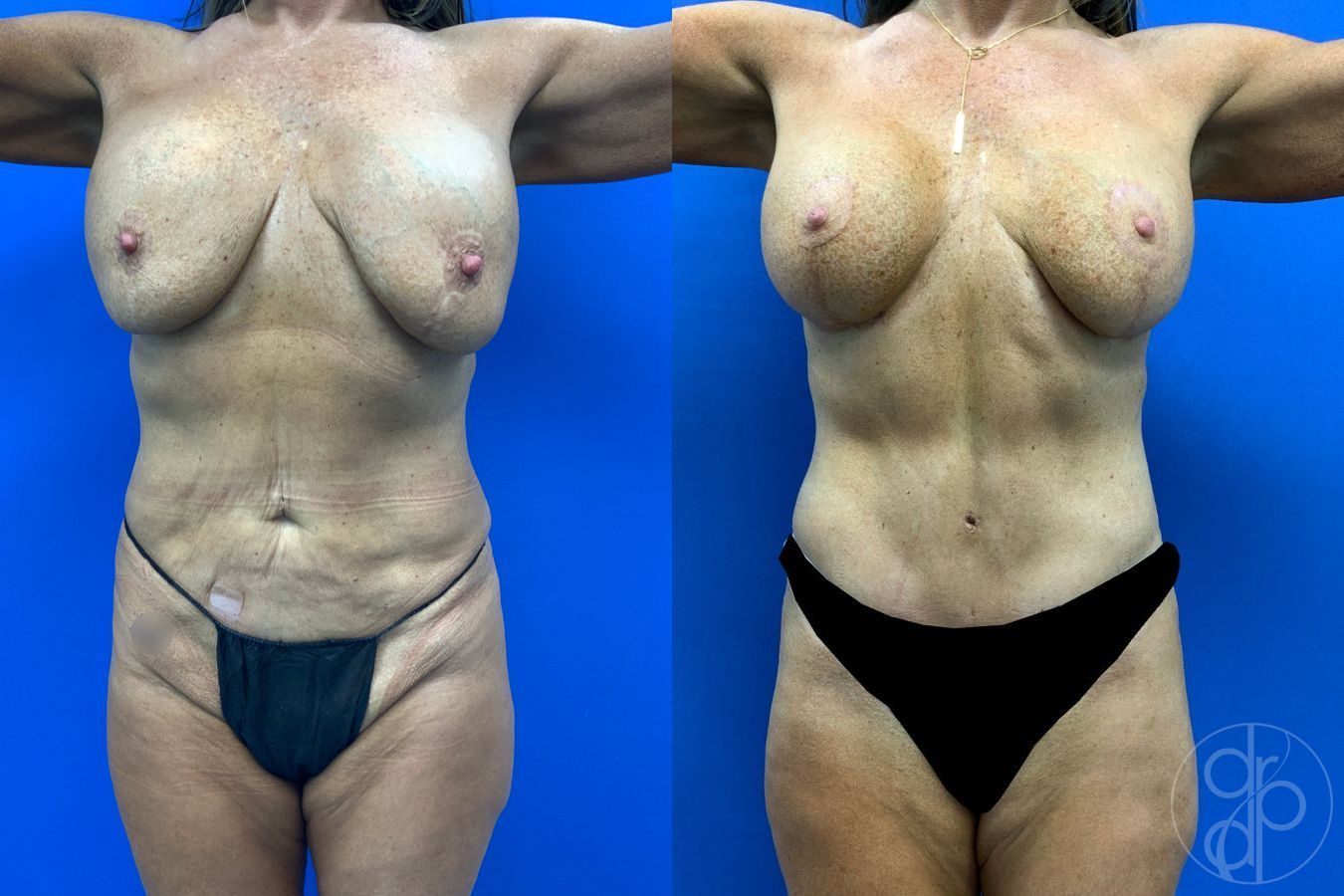 Before and after Mommy Makeover case 50316 - Angle 2