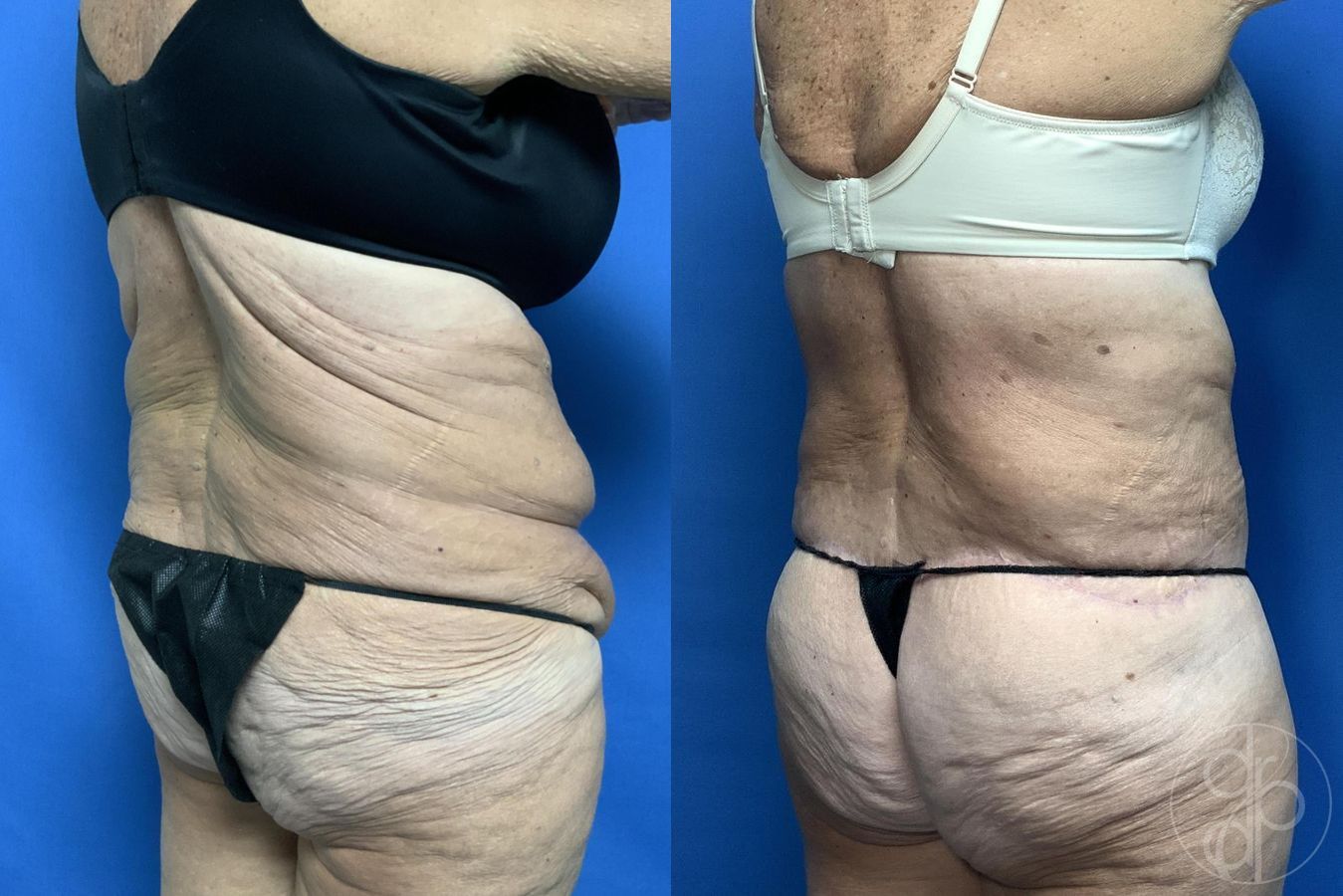 Before and after Abdominoplasty case 29620 - Angle 6