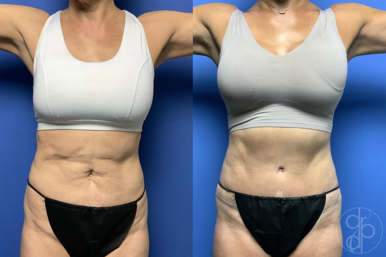 Before and after Abdominoplasty case 29647 - Angle 2