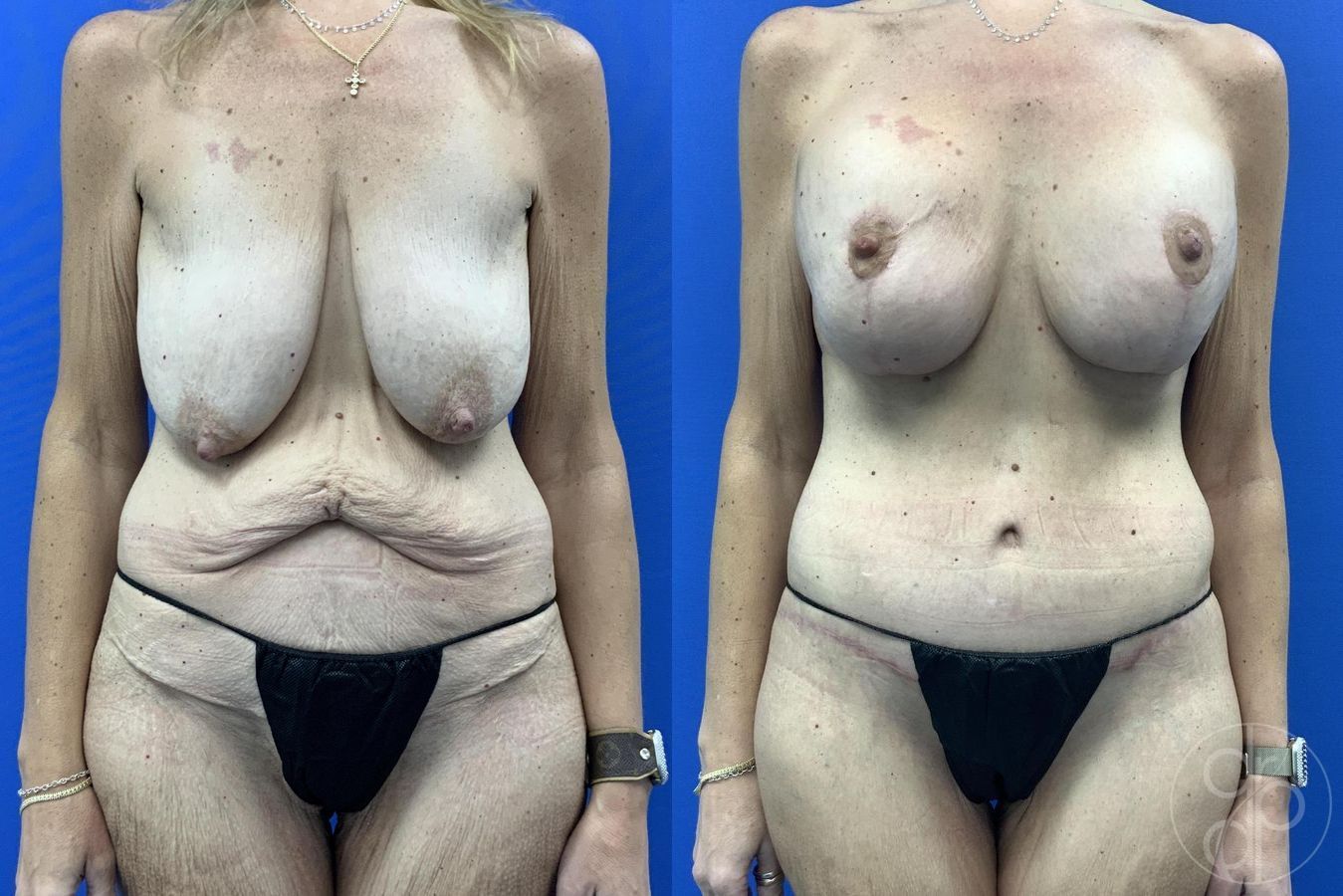 Before and after Abdominoplasty case 29983